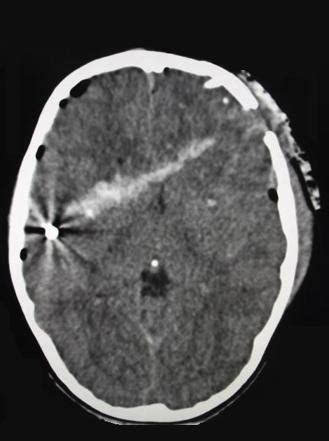 High-velocity penetrating brain injury | Radiology Reference Article ...