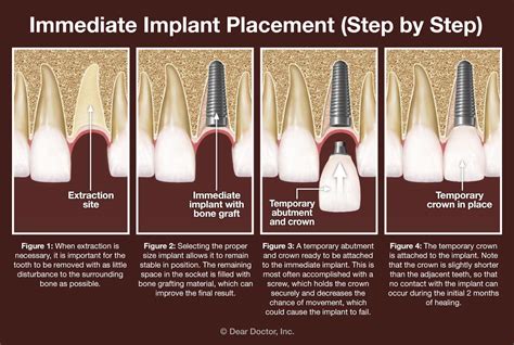 Immediate Dental Implants