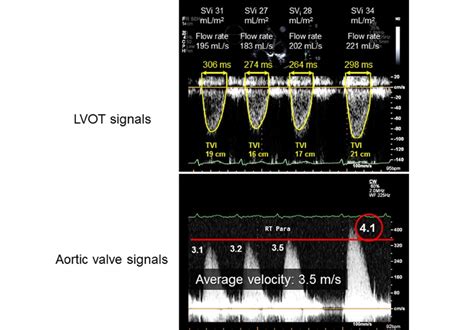 Aortic stenosis severity underestimated when mean gradient is obtained during atrial ...