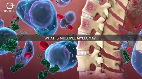 What Is Multiple Myeloma? Symptoms & Treatment | Babirus LLC