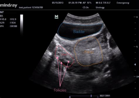 Ultrasound Leadership Academy: The Basics of Pelvic Transabdominal Ultrasound — EM Curious