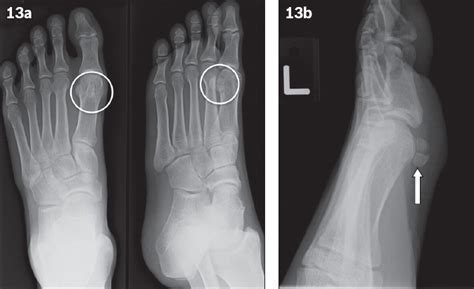 Common accessory ossicles of the foot: imaging features, pitfalls and associated pathology | SMJ