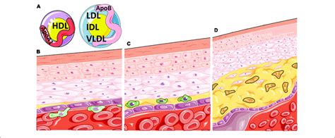 | Atherosclerosis is a disease of inflammation and lipids. (A)... | Download Scientific Diagram