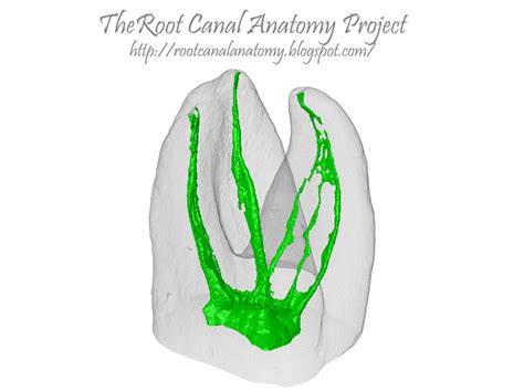 The Root Canal Anatomy Project: Middle Mesial Canal: Maxillary First Molar