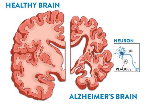 Your Brain and Alzheimer's - Fisher Center for Alzheimer's Research ...