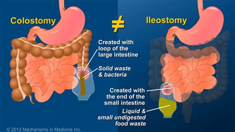 What is an Ileostomy?