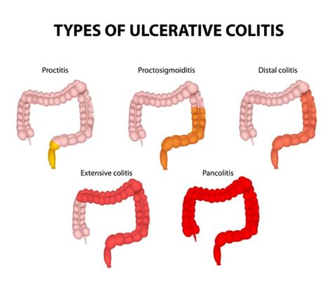 Pancolitis : Causes, Picture, Symptoms And Treatment