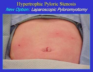 Pediatric Hypertrophic Pyloric Stenosis Surgery Workup: Laboratory Studies, Imaging Studies ...