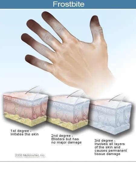 Frostbite (Frostnip): Treatment, Symptoms, Prevention - Okkii.com