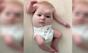 Baby Born With Face On Torso and No Head Might Be ‘Creepiest Ever,’ Says Doctor | Empire News