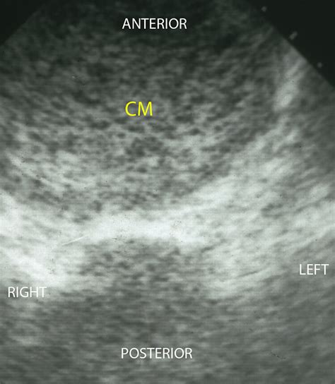 Complete Hydatidiform Mole Ultrasound | Hot Sex Picture