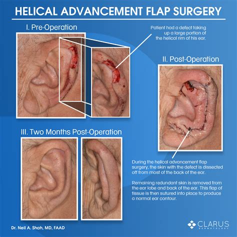 Helical Advancement Flap Surgery - Clarus Dermatology Medical Surgical ...