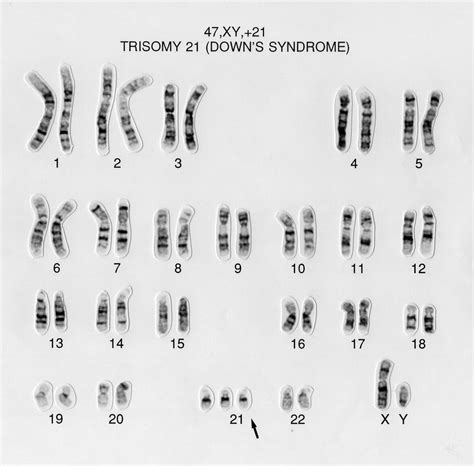 International Mosaic Down Syndrome Association Explaining Karyotypes | My XXX Hot Girl