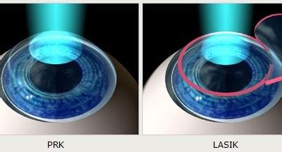 Femto-lasik & Lasik laser operations | فيمتوليزك وعمليات العيون وتصحيح ...