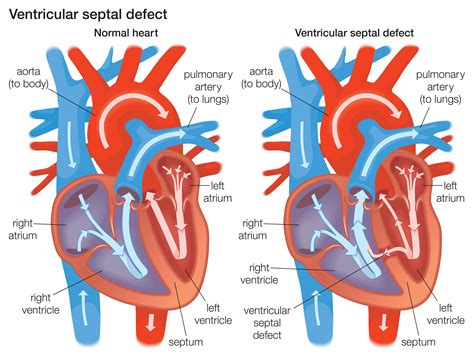 What Are Ventricular Septal Defects?
