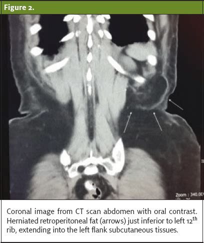 Lumbar Hernia: An Unusual Cause of Back Pain - Journal of Urgent Care ...