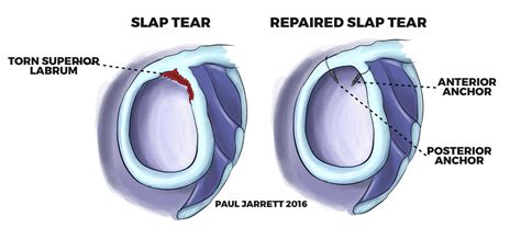 Biceps Tendon Pathology - Dr Paul Jarrett, Orthopaedic Surgeon Perth