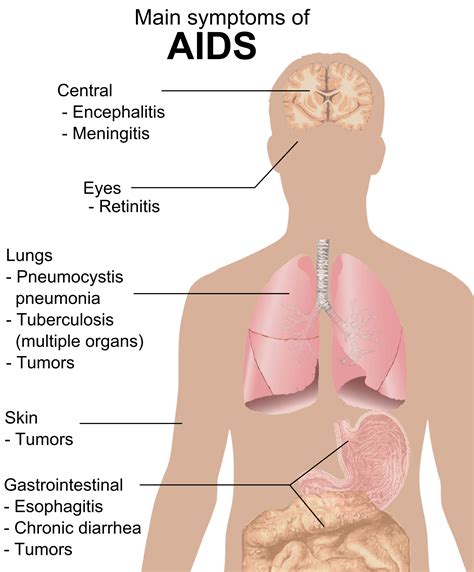 File:Symptoms of AIDS.png - Wikipedia, the free encyclopedia
