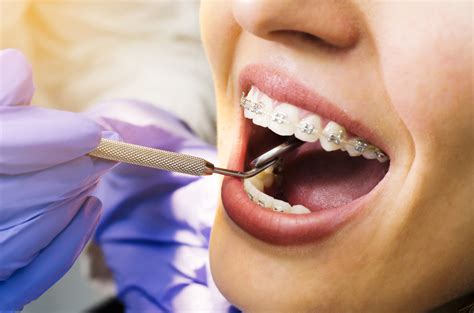 Dental Braces Treatment Details | Removal & Recovery