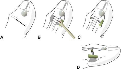 Total Dorsal Capsulectomy for the Treatment of Mucous Cysts - Journal ...