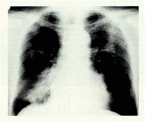 Figure 1 from Acquired childhood aphasia with convulsive disorder ...