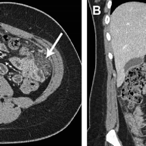 Omental malignant mesothelioma. A. The tumor cells are reactive with... | Download Scientific ...