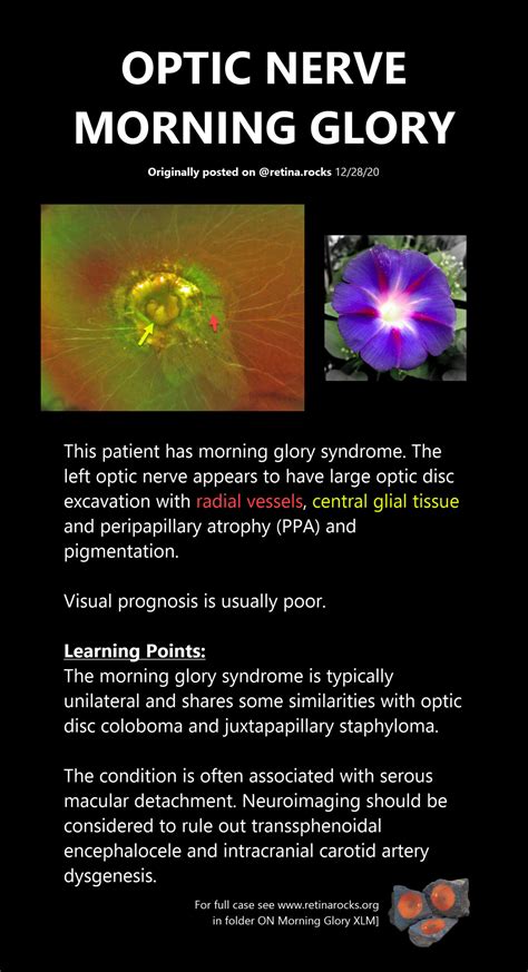 Optic Nerve Disorders > Morning Glory Syndrome - Retina Rocks