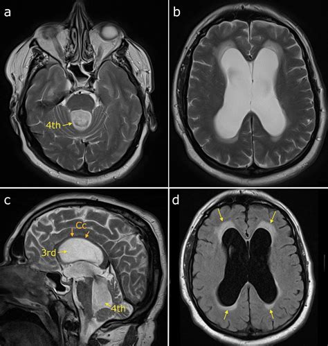 Obstructive hydrocephalus - Radiology at St. Vincent's University Hospital