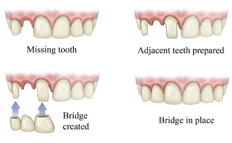 Everything You Wanted to Know about Dental Bridges | Joshua Hong DDS ...