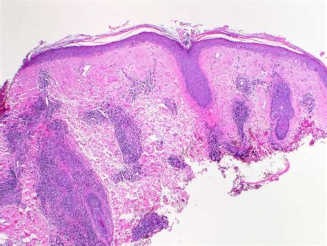 Subacute Cutaneous Lupus Erythematosus (SCLE) - Dermatology Advisor