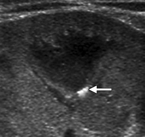 Renal Pyramids Ultrasound