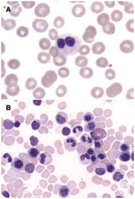 A case of benign Pelger-Huët anomaly