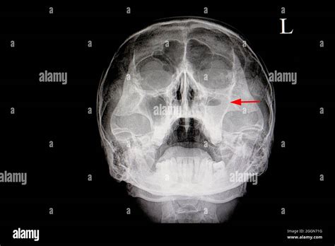 xray film of a skull of a patient (paranasal sinus) with acute right maxillary sinusitis (red ...