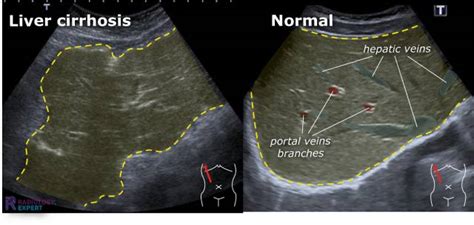 Abdominal ultrasound