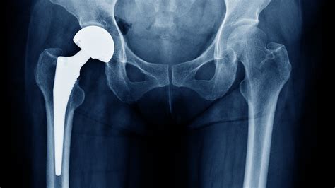 Hip Replacement Materials - The Best & Worst Kinds To Use