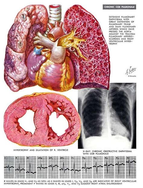 Cor pulmonale - SMARTY PANCE