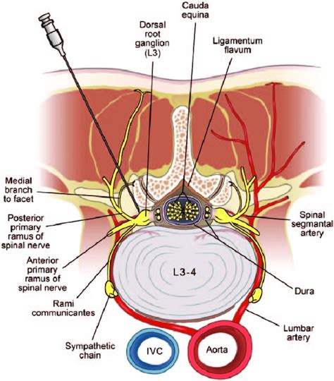 Anatomy Of A Needle - Anatomical Charts & Posters