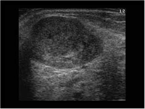 Pleomorphic Adenoma Parotid