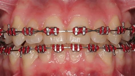 √ Awesome Braces Colors