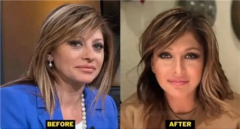 Maria Bartiromo Plastic Surgery: Maria Bartiromo Plastic Surgery 2023 - Stanford Arts Review