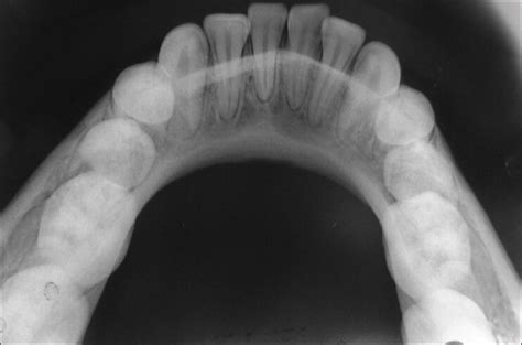 Anterior occlusal radiograph of mandibular arch showing presence of a... | Download Scientific ...