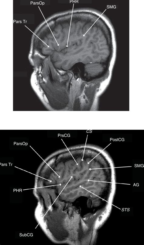 Figures 3, [Lateral sagittal T1-weighted MRI scans...]. - Glioblastoma ...