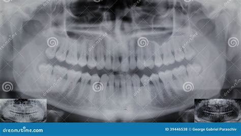 Panoramic Dental X-ray - 32 Teeth - 4 Wisdom Stock Photo - Image: 39446538