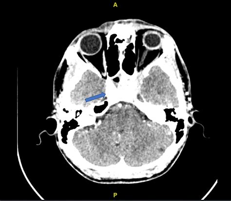 Causes Of Cavernous Sinus Thrombosis