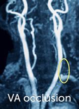 13. Vertebral Artery Pathologies | 123sonography