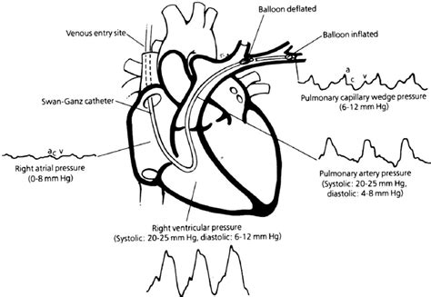 2. Pressure waveforms in PAC (from: Disease-a-month.The Swan Ganz ...