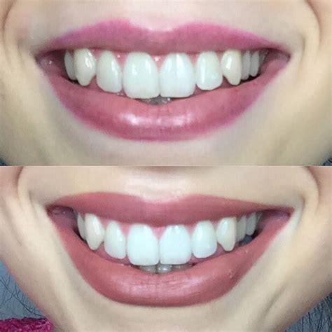 HiSmile Teeth Whitening Kit | Review + Before & After | Rebekah with Love