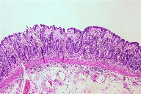 Collagenous Colitis | Ed Uthman | Flickr