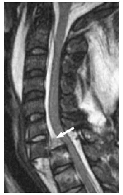 Anterior Longitudinal Ligament Injury Mri