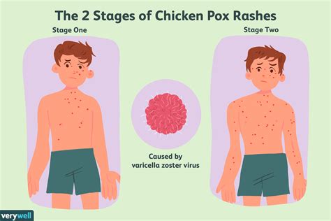 Treatments for Chickenpox: Home Remedies and More